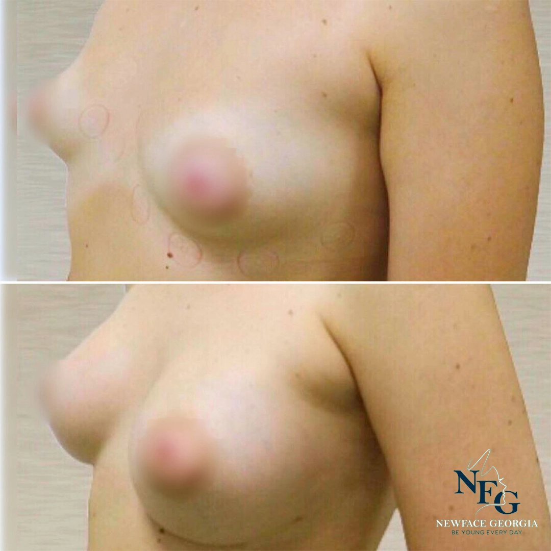 After-Breast surgery